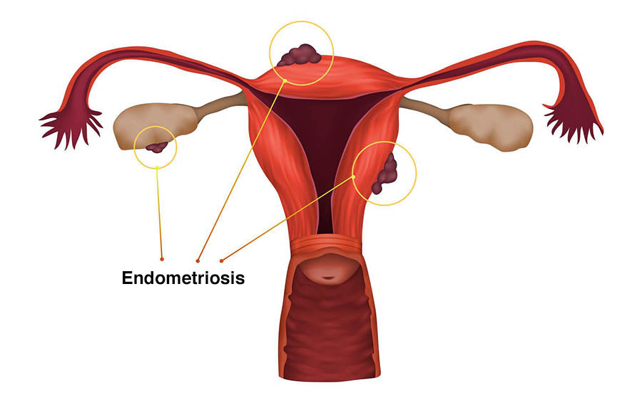 Endometrioza – boala secolului