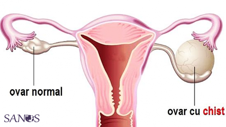 Chistul ovarian: tipuri, cauze, simptome, prevenție